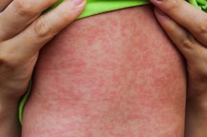 Cách phòng ngừa bệnh thủy đậu ở trẻ em